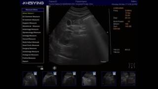 ULTRASOUND DUODENUM amp PYLORIC SPHINCTER [upl. by Venus]