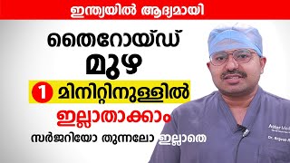 തൈറോയ്ഡ് മുഴ 1 മിനിറ്റിനുള്ളിൽ ഇല്ലാതാക്കാം സർജറിയോ തുന്നലോ ഇല്ലാതെ  Goiter Enlarged Thyroid [upl. by Dranel]