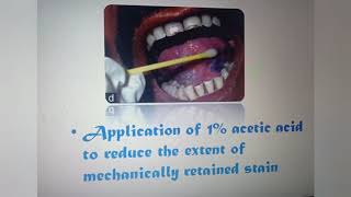 Toluidin Blue staining procedure for early detection of oral cancerous lesion [upl. by Ailices]