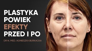 Plastyka powiek górnych blefaroplastyka  przed i po [upl. by Korns616]