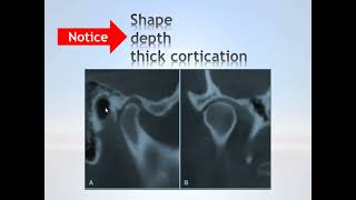 Imaging of TMJ [upl. by Laurentium]