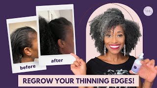 The Ultimate Guide to Regrowing Thinning Hair Edges [upl. by Selin]