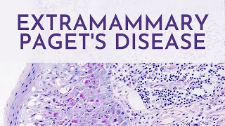 Extramammary Pagets Disease  Pathology mini tutorial [upl. by Flannery]