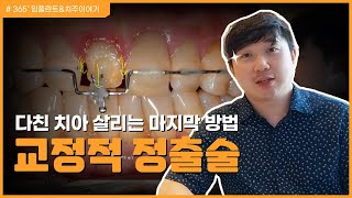 넘어져서 깨진 앞니 살리는 방법 교정적 정출술  교정적 정출술  다친 치아 살리기  깨진 앞니 [upl. by Anav952]