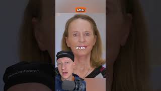 AMAZING Facelift amp Laser Resurfacing Transformation  Plastic Surgeon Reacts [upl. by Lindsey]