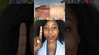 How to Treat Tinea Versicolor skincare tineaversicolor [upl. by Yrbua]