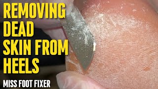 Foot scraping How to remove dead skin from heels in Minutes full treatment by miss foot fixer [upl. by Ecinuahs]