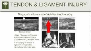 Prolotherapy  Part 3  Joint Pain Tendonitis amp Ligament Pain [upl. by Llecrad]