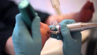 Laser treatment of Verruca [upl. by Lait]