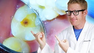 Dentist Filling a Cavity Step by Step With Decay Removal and a Class 1 White Composite Resin [upl. by Schenck]