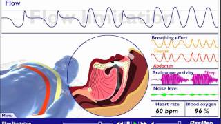 Understanding Sleep Disordered Breathing [upl. by Hgielrak]