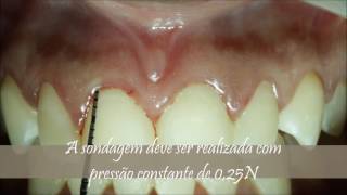 Caso clínico de sondagem periodontal [upl. by Rinum756]