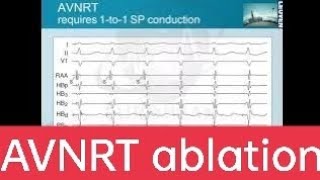 AVNRT ablation avnodalreentrytachycardia EPstudy bestcardiology [upl. by Yllod]