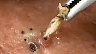 SATISFYING BLACKHEAD REMOVAL ear 2020 October [upl. by Eeniffar]