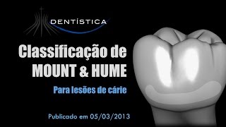 Classificação de MOUNT amp HUME para lesões de cárie [upl. by Killigrew454]