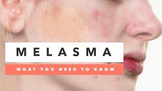 What You Need To Know About Melasma  Causes amp Treatments [upl. by Manthei]