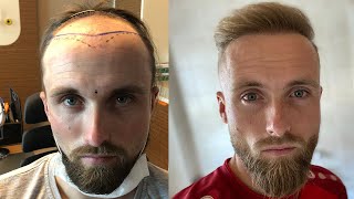 Hair Transplant Before and After  Month by Month Results  Elithair [upl. by Forster]