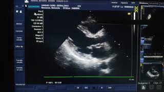 Prolapso Valvular Mitral de valva posterior Explicación del ecocardiograma [upl. by Nosredneh]