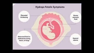 HYDROPS FETALIS ULTRASOUND FEATURES [upl. by Bergin439]