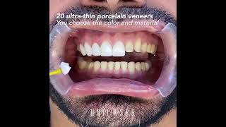 Porcelain veneers This is how we do it [upl. by Manuel]