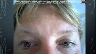 Neuroophthalmology Horner Syndrome [upl. by Egdamlat395]