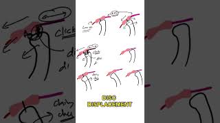 TMJ Disc Displacement  Disc Dislocation with Reduction  Disc Dislocation without reduction [upl. by Ragde]