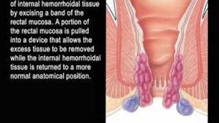 procedure for prolapsing hemorrhoids [upl. by Rebmyt339]