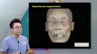 Chapter 6 Clinical anatomy of the nose for filler augmentation procedures [upl. by Schroth8]