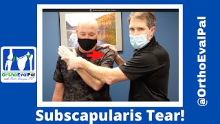 Subscapularis Rotator Cuff Tear [upl. by Amanda]