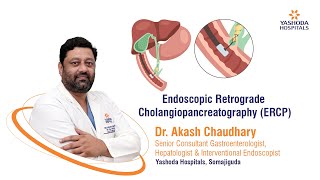 Endoscopic Retrograde Cholangiopancreatography  ERCP  Yashoda Hospitals Hyderabad [upl. by Dulcle545]