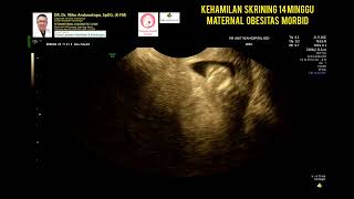 Skrining 14 minggu Maternal Obesitas Morbid [upl. by Debera]