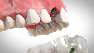 Single Tooth Implant StepbyStep Guided Surgery Explained  TeethXpress Procedure [upl. by Enyalaj570]