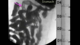 09 Intestinal hypermotility in fed state [upl. by Icam]