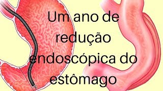 Um ano de gastroplastia endoscópica [upl. by Hannon]