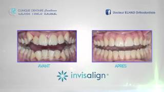 Cas Clinique  INVISALIGN [upl. by Butterfield]