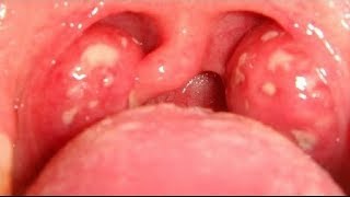 Tonsillitis Pictures  Signs Symptoms Causes Photos Images Pictures of Tonsillitis  Tonsils [upl. by Salome]