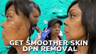 DPN removal for smoother skin [upl. by Annat]