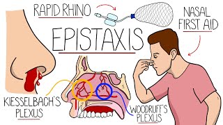 Understanding Epistaxis Nosebleeds Explained [upl. by Alodee918]