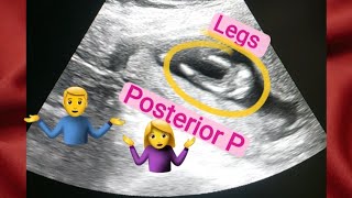 13 weeks oregnant gender reveal  posterior placenta means baby boygirl  how to tell gender on usg [upl. by Gretal]