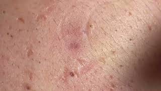 Acne Treatment Huong Da Nang  2024 blackheads 703 [upl. by Nirual]