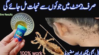 Sar Ki Juen Khatam Karne Ka Tarika Head Lice RemovalTreatment At Home  Anti Lice by Amna sheikh [upl. by Yerffoeg293]