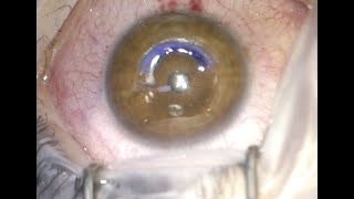 CAIRS Corneal Allogenic Intrastromal Ring Segments for keratoconus [upl. by Naitirb]