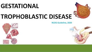 Gestational Trophoblastic Disease  RCOG guideline 2020 [upl. by Sirahc]