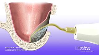 PIEZOSURGERY® Sinus Lift Technique by lateral approach animation [upl. by Devonna]