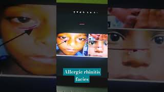 Allergic shiners allergic salute allergic rhinitis facieshigh arched palate open mouth breathing [upl. by Notsirt216]