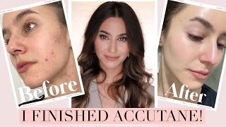 I FINISHED ACCUTANE 🎉 Results  Side Effects Low Dose Isotretinoin Journey  Karima McKimmie [upl. by Dray]