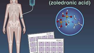 Zoledronate in Osteopenia [upl. by Sonja783]