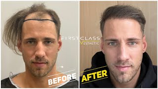 Hair Transplant Growth Timeline  Day 1 To Day 365 Before amp After  FirstClassEsthetic in Turkey [upl. by Cheng]