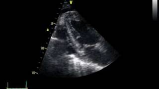 CHRONIC PERICARDITIS with thickening of the pericardium [upl. by Nogas900]