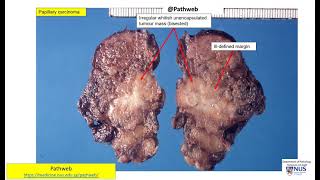 Thyroid Papillary thyroid carcinoma  Gross and Micro [upl. by Moise466]